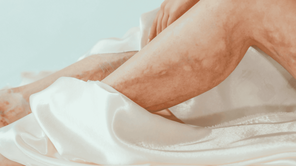 IVC | Dr. Antonio Queiroz | Cirurgião Vascular