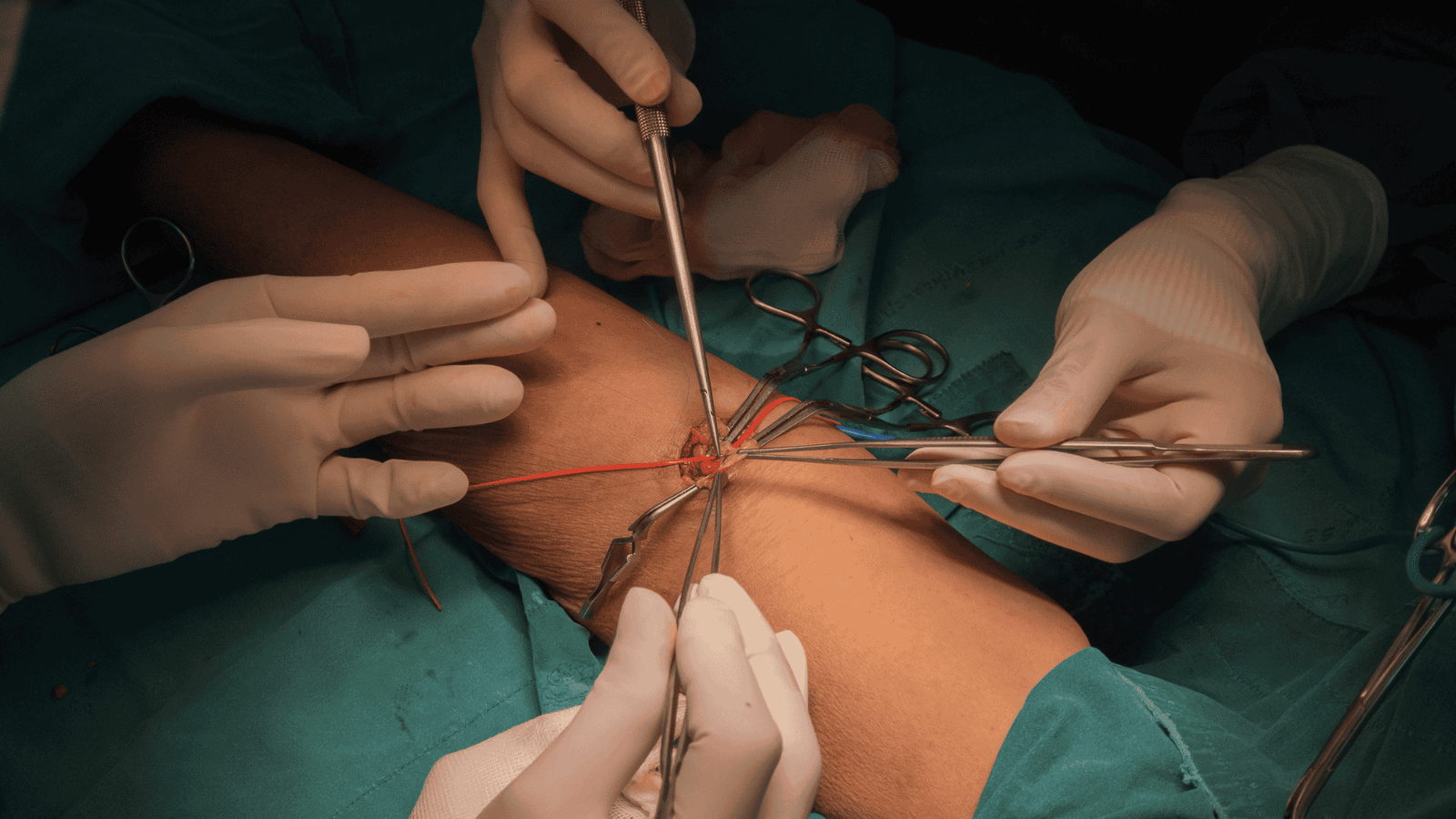 FAV | Dr. Antonio Queiroz | Cirurgião Vascular