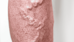 Flebite e Tromboflebite Superficial | Dr. Antonio Queiroz | Cirurgião Vascular