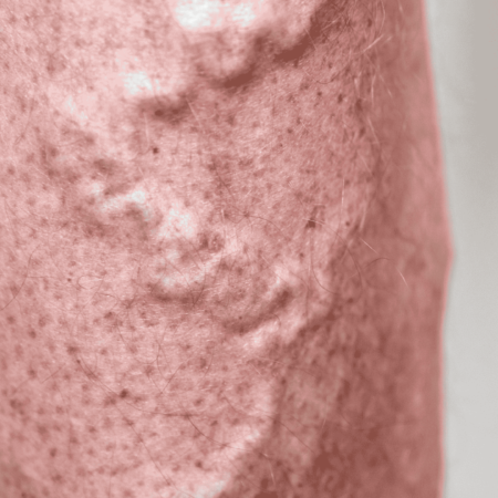 Flebite e Tromboflebite Superficial | Dr. Antonio Queiroz | Cirurgião Vascular