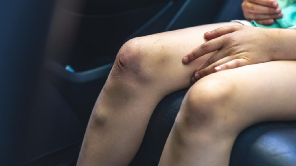 Varizes | Dr. Antonio Queiroz | Cirurgião Vascular