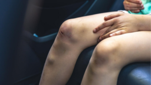 Varizes | Dr. Antonio Queiroz | Cirurgião Vascular