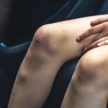 Varizes | Dr. Antonio Queiroz | Cirurgião Vascular