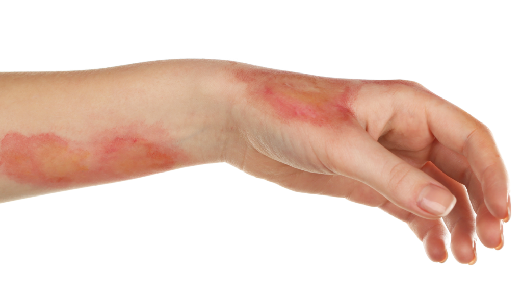 Eritromelalgia 6 Causas, Sintomas e Tratamento das Mãos e Pés Vermelhos | Dr. Antônio Queiroz